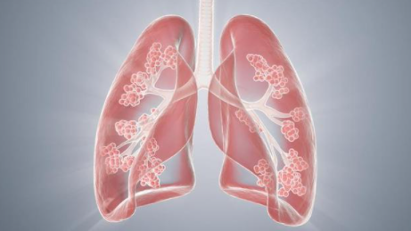 肺部结节最怕三个征兆