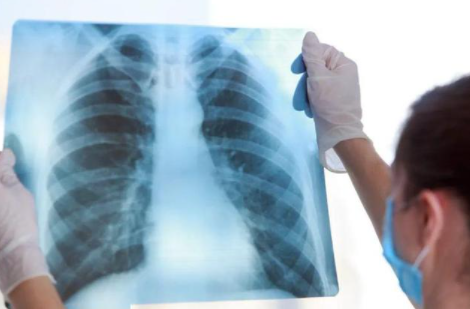 肺部结节最怕三个征兆