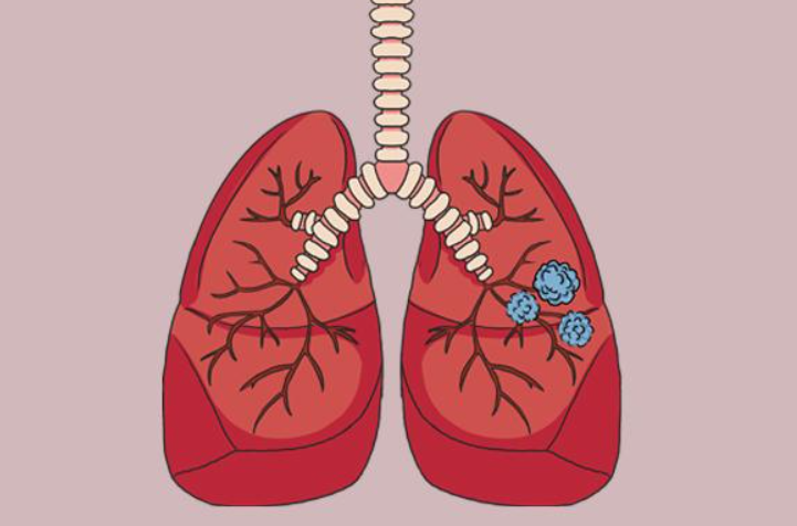 肺部有结节是怎么回事?要紧吗?