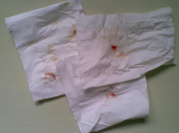 肺部结节最怕三个征兆