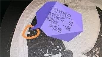 肺部结节
