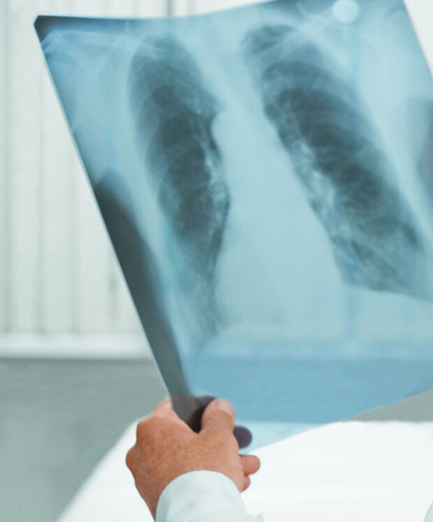 肺结节怎么治疗