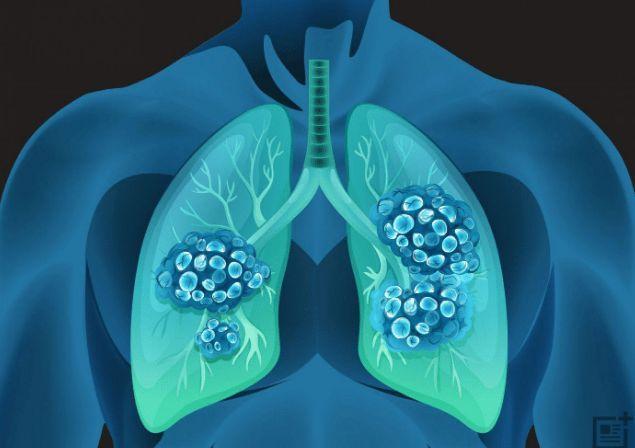 肺部有结节是怎么回事?要紧吗?