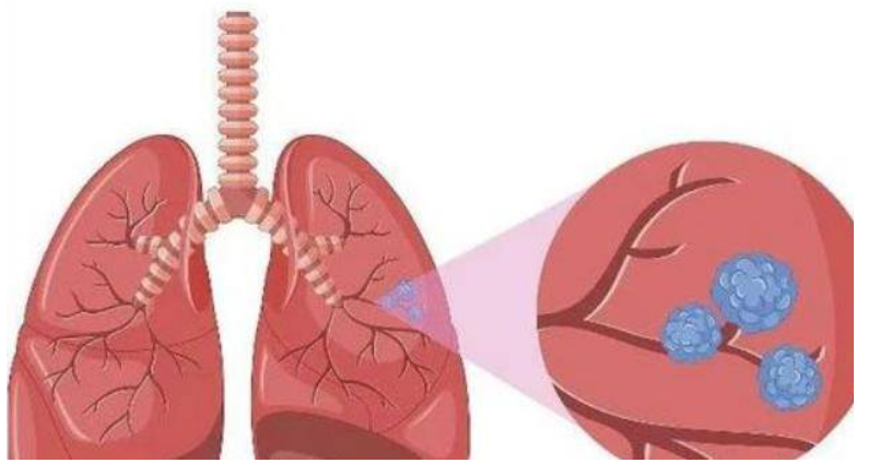 肺部ct有结节