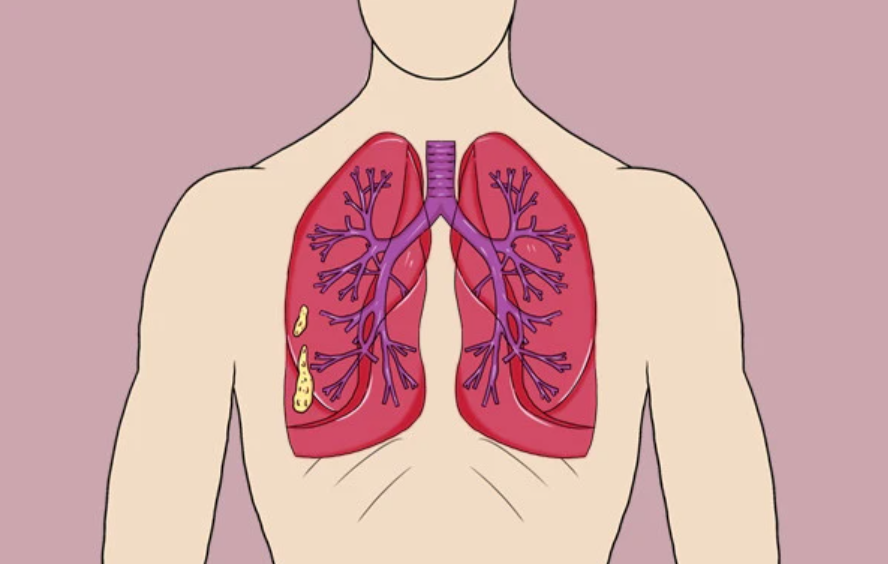 双肺有小结节