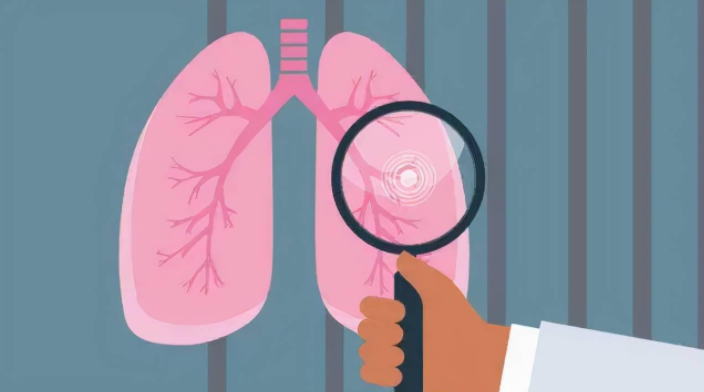 肺部结节形成原因
