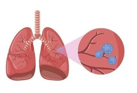 肺结节怎么治疗