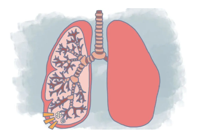 肺部有结节是怎么回事？要紧吗？
