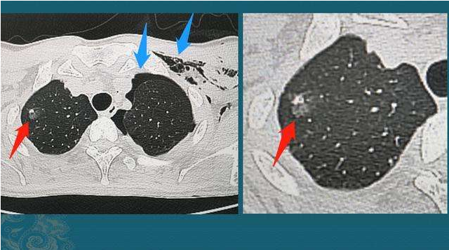 肺部ct有结节