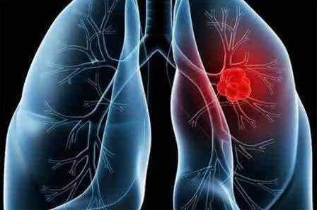 肺部结节是怎么回事？要紧吗？