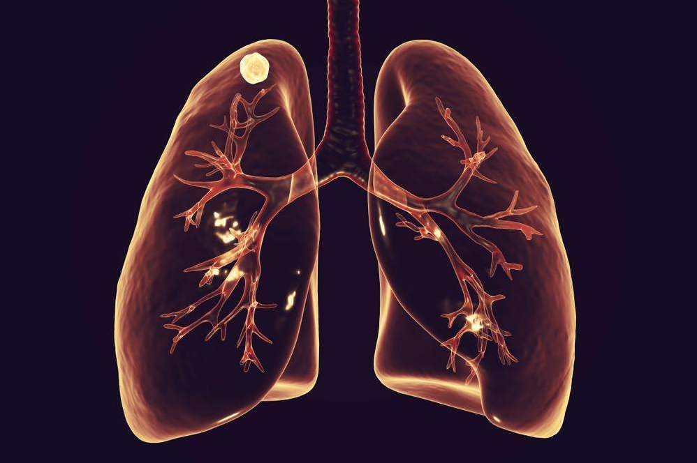 肺部有结节怎么是回事？要紧吗？