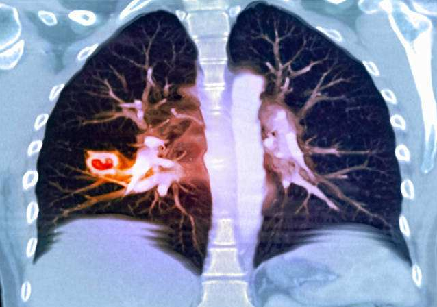 肺上结节80%是肺癌吗