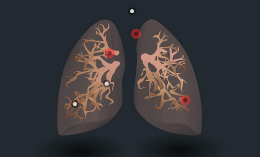 肺上有结节是怎么回事