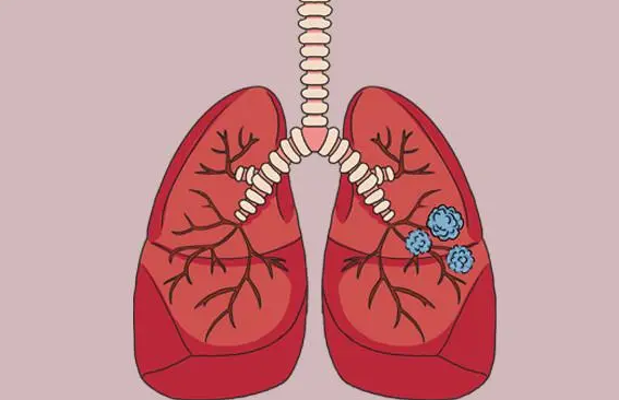 肺有结节怎么办