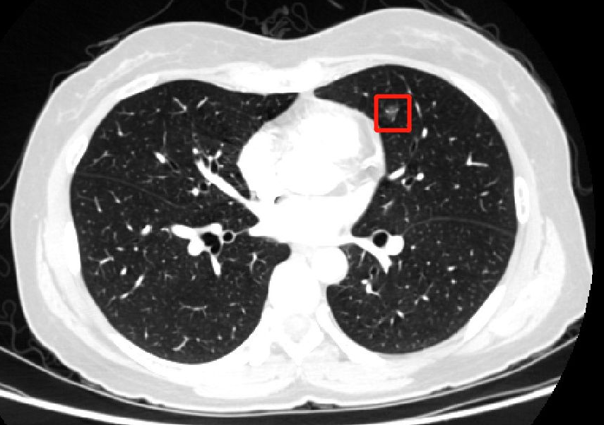 双肺有小结节