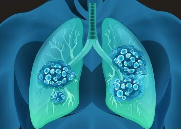 肺结节形成原因