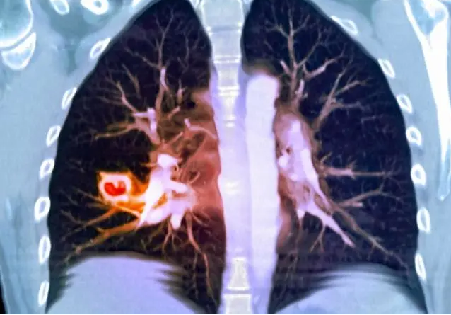 肺部有结节是怎么回事？要紧吗？