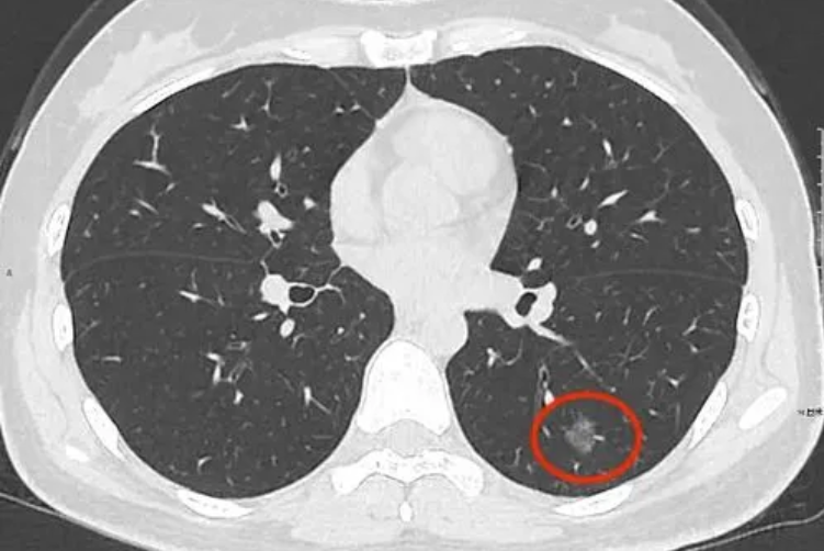 左肺下叶微小结节是什么意思