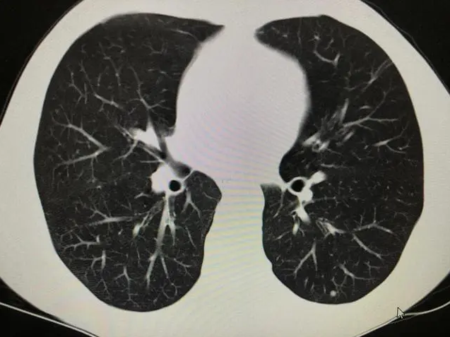 肺上结节80%是肺癌吗
