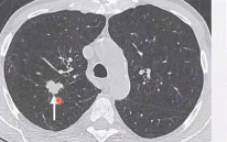 肺部ct有结节