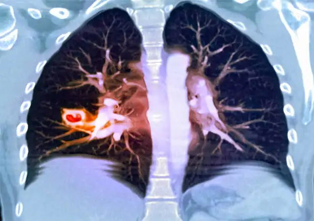 肺部结节最怕三个征兆