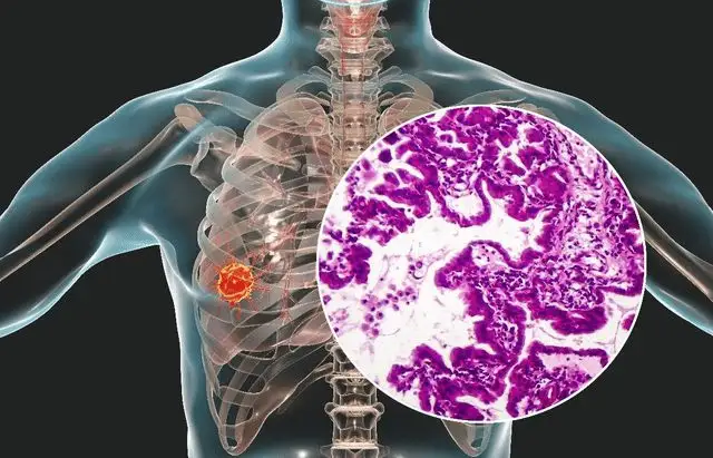 肺上有结节是怎么回事