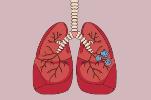 肺结节吃什么药能散结