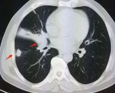 肺部有结节是怎么回事？要紧吗？
