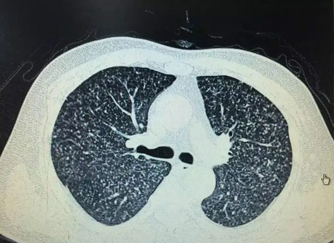 肺结节怎么治疗 肺结节怎么治疗