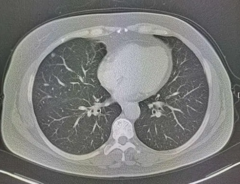 肺部结节最怕三个征兆