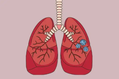 肺部结节最怕三个征兆