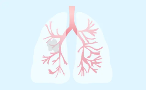 肺有结节怎么办