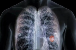 肺部有结节是怎么回事？要紧吗？