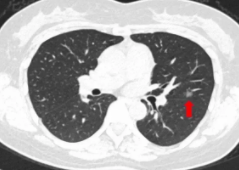 肺部有结节是怎么回事？要紧吗？