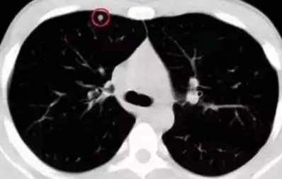 肺结节是什么意思