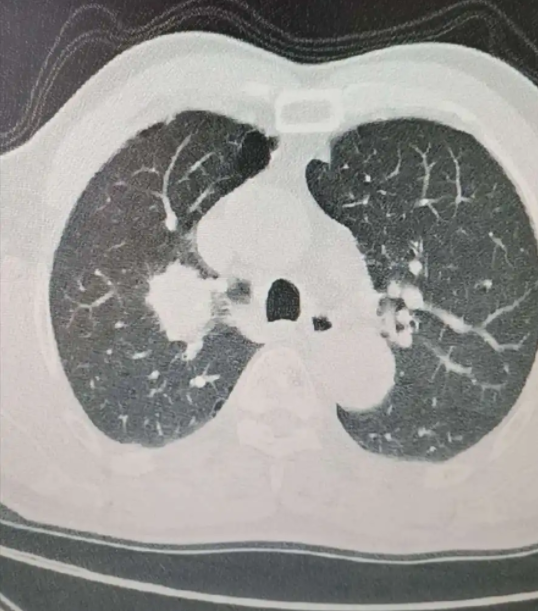 肺有结节怎么办