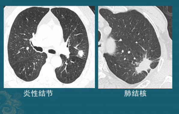 肺部结节 肺部结节