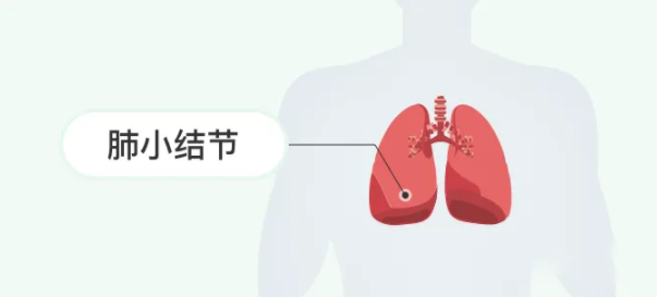 肺部小结节