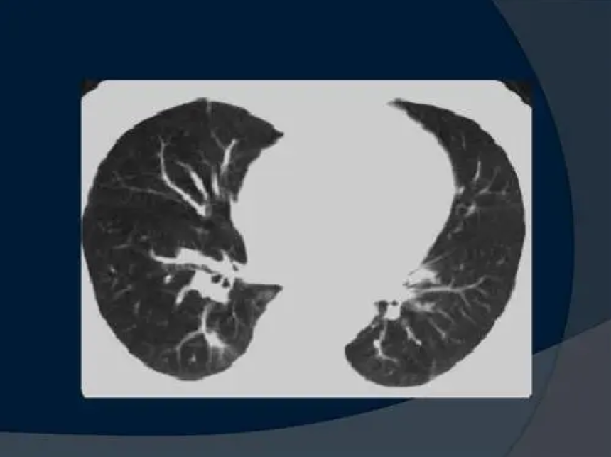 肺有结节怎么办