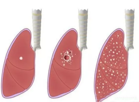 肺部结节形成原因