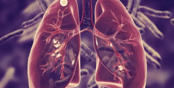 肺有结节怎么办