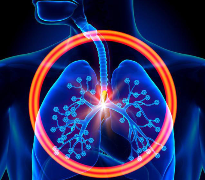 肺部结节如何随访