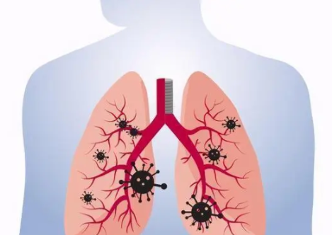 肺上有结节是怎么回事