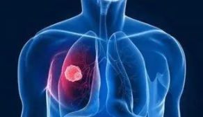 肺结节怎么治疗