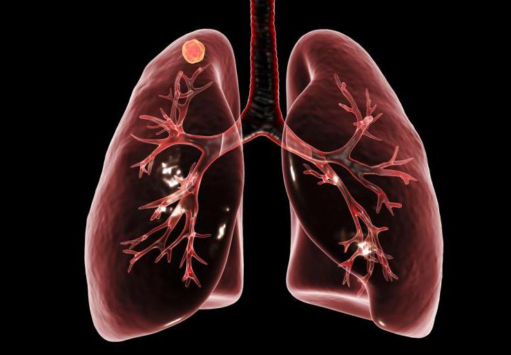 肺部有结节是怎么回事？要紧吗？