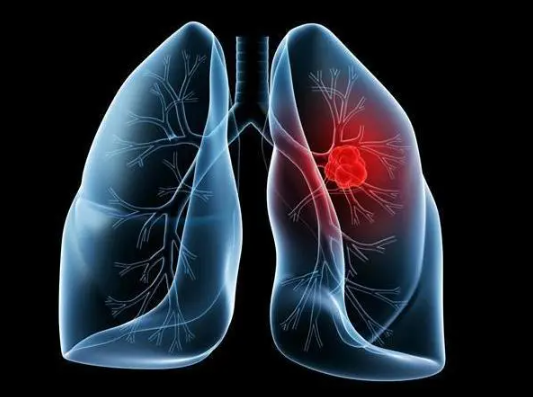 肺结节是什么意思