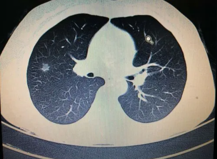 肺部ct有结节