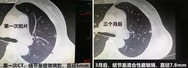 肺结节怎么治疗