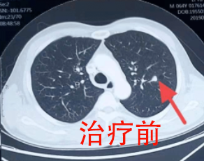 肺有结节怎么办 肺有结节怎么办