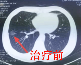 肺部结节
